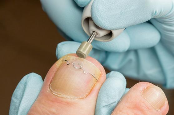 Traitement Ongle incarné Traitement Ongle incarné