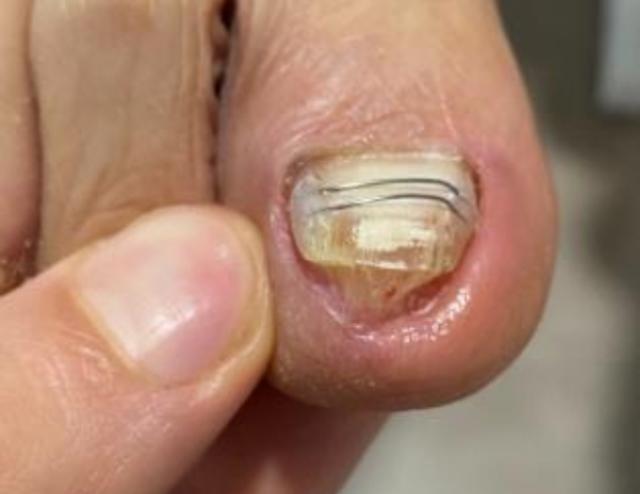 Traitement Ongle incarné